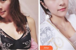 昆明麗都醫(yī)療美容醫(yī)院董玉潔整形價(jià)格表附自體脂肪隆胸案例展示