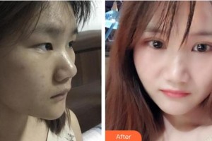 昆明達(dá)美醫(yī)療美容診所游桂萍整形價(jià)格表附埋線雙眼皮案例展示