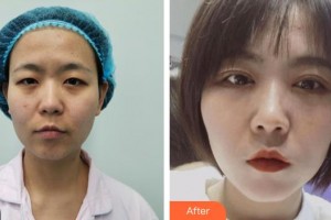 昆明前衛(wèi)美眼整形專科診所夏玲整形價(jià)格表附眼部綜合案例展示