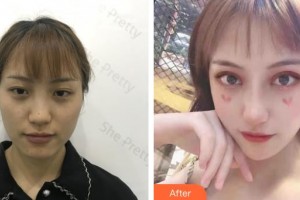 昆明前衛(wèi)美眼整形?？圃\所吳瓊整形價(jià)格表附切開雙眼皮案例展示