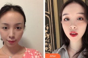 昆明同仁醫(yī)院醫(yī)療美容科黃玉華整形價(jià)格表附眼部綜合案例展示