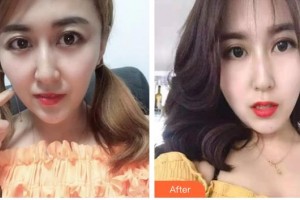 昆明夢想醫(yī)療美容醫(yī)院高婷婷整形價格表附激光去黑眼圈案例展示