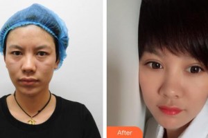 昆明市第一人民醫(yī)院星耀醫(yī)院張正秀整形價格表附外切祛眼袋案例展示