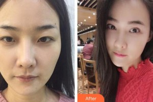 昆明璀璨人生醫(yī)療美容診所肖軍磊整形價格表附眼部綜合案例展示