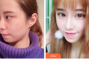 昆明華山眼科醫(yī)院李蘊秀整形價格表附切開雙眼皮案例展示