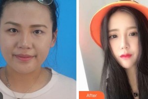 昆明醫(yī)科大學(xué)第二附屬醫(yī)院整形外科王繼華整形價(jià)格表附切開雙眼皮案例展示