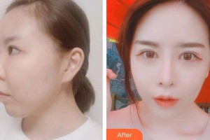 昆明華山眼科醫(yī)院和志清整形價格表附切開雙眼皮案例展示