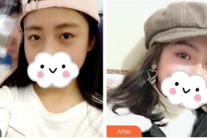 昆明醫(yī)科大學第二附屬醫(yī)院整形外科戴榮琴整形價格表附眼部綜合案例展示