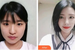 昆明醫(yī)科大學第二附屬醫(yī)院整形外科朱禮昆整形價格表附眼部綜合案例展示