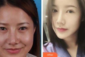 昆明華山眼科醫(yī)院范黎妮整形價格表附眼部綜合案例展示