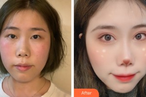 南寧熠美醫(yī)療美容診所徐贊正整形價格表附雙眼皮手術(shù)案例展示