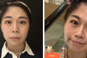 南寧悅美韓星醫(yī)療整形美容醫(yī)院陳俊武整形價(jià)格表附瘦臉案例展示