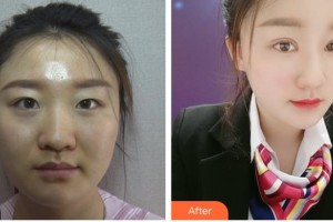 昆明普瑞眼科醫(yī)院袁援生整形價格表附定點(diǎn)雙眼皮案例展示