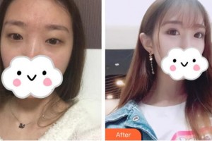 昆明普瑞眼科醫(yī)院岳以英整形價格表附定點(diǎn)雙眼皮案例展示