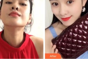 昆明愛爾眼科醫(yī)院董雪蓮住院醫(yī)師整形價格表附定點(diǎn)雙眼皮案例展示