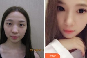 昆明普瑞眼科醫(yī)院葉計芬整形價格表附切開雙眼皮案例展示