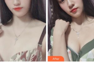 遵義韓美整形美容醫(yī)院王祥整形價格表附自體脂肪隆胸案例展示