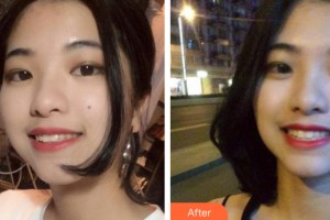 武漢美嘉整形美容醫(yī)院毛杰整形價格表附牙齒矯正案例展示