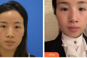 昆明市延安醫(yī)院杰西艾美容醫(yī)院張四文教授整形價(jià)格表附激光去眼袋案例展示