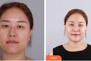 昆明普瑞眼科醫(yī)院楊槐整形價格表附眼部綜合案例展示