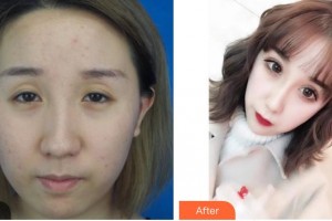 昆明拜博口腔醫(yī)院段錦益整形價格表附眼部綜合案例展示