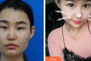 昆明阿瑪施眼科門診部陳寶芹整形價格表附眼部案例展示