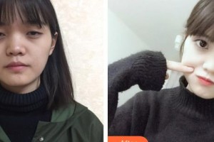 昆明眼科醫(yī)院袁俊彥整形價格表附開內(nèi)眼角案例展示