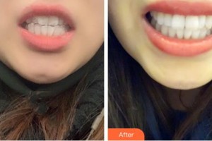 昆明拜博口腔醫(yī)院高建乙整形價格表附隱形托槽矯正案例展示