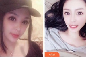 昆明拜博口腔醫(yī)院劉凡瑜整形價格表附牙齒隱形矯正案例展示