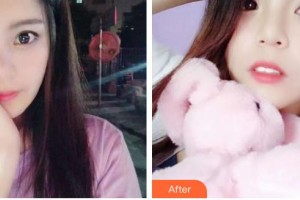 昆明拜博口腔醫(yī)院韓影整形價格表附牙齒隱形矯正案例展示