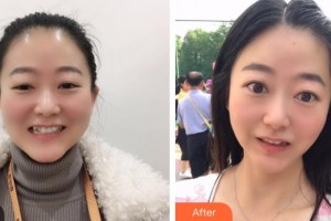 昆明拜博口腔醫(yī)院吳艷芳整形價格表附牙齒隱形矯正案例展示