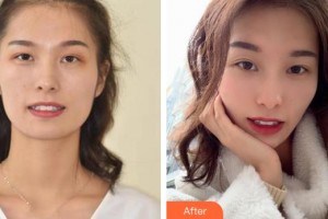 昆明拜博口腔醫(yī)院周莉整形價格表附牙齒隱形矯正案例展示