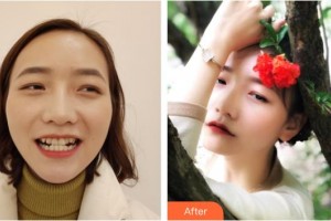 昆明拜博口腔醫(yī)院張丹丹整形價格表附牙齒隱形矯正案例展示