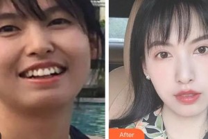 昆明拜博口腔醫(yī)院施琳玲整形價(jià)格表附金屬托槽矯正案例展示