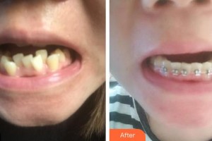 昆明拜博口腔醫(yī)院王海龍整形價(jià)格表附隱形托槽矯正案例展示