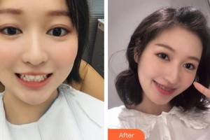 昆明尚愛韓美口腔門診部徐道美整形價(jià)格表附隱形托槽矯正案例展示