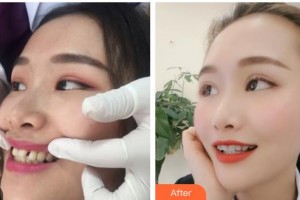 昆明先行口腔門診部戴文娟整形價格表附金屬托槽矯正案例展示