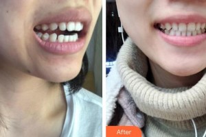 昆明愛雅仕口腔醫(yī)院滕飛整形價(jià)格表附牙齒隱形矯正案例展示