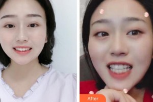 昆明愛雅仕口腔醫(yī)院劉欣整形價(jià)格表附金屬托槽矯正案例展示