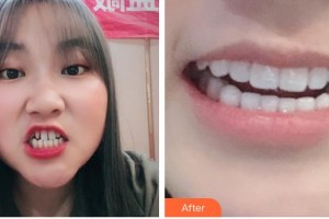 昆明吳氏嘉美美容醫(yī)院白孝梅整形價(jià)格表附牙齒陶瓷矯正案例展示