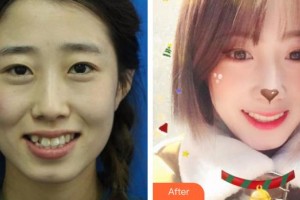 昆明醫(yī)科大學(xué)附屬口腔醫(yī)院億大口腔門診部滕芃妍整形價(jià)格表附牙齒隱形矯正案例展示