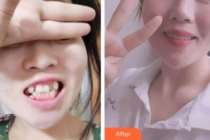 昆明藍(lán)橙口腔醫(yī)院吳拓江整形價(jià)格表附牙齒隱形矯正案例展示