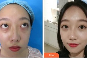 曲靖市第二人民醫(yī)院眼科薛海蘭整形價(jià)格表附眼部修復(fù)案例展示