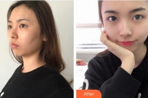 曲靖愛爾眼科醫(yī)院楊亦整形價(jià)格表附眼部綜合案例展示