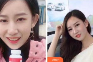 曲靖卓美口腔門診部張小米整形價(jià)格表附牙齒隱形矯正案例展示