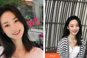 玉溪左醫(yī)生整形美容門診部左玉萍整形價(jià)格表附去痘印痘坑案例展示