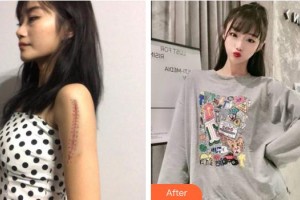 玉溪左醫(yī)生整形美容門診部傅家友整形價(jià)格表附手術(shù)祛疤案例展示