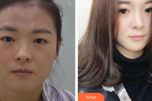 玉溪華山眼科醫(yī)院金發(fā)祥整形價格表附眼部綜合案例展示