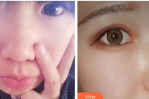 玉溪華山眼科醫(yī)院楊躍整形價格表附切開雙眼皮案例展示