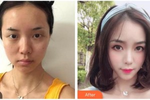 玉溪曹汝智醫(yī)療美容診所曹汝智整形價格表附眼部綜合案例展示